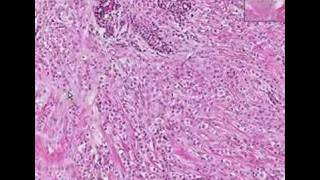 Histopathology BreastLobular carcinoma [upl. by Rosalind588]